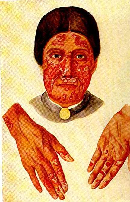 Historical Descriptions of Lupus 14 th century skin lupus 16 th century - "Leprosy is more clearly recognized in the nose, where it shows well-defined symptoms.