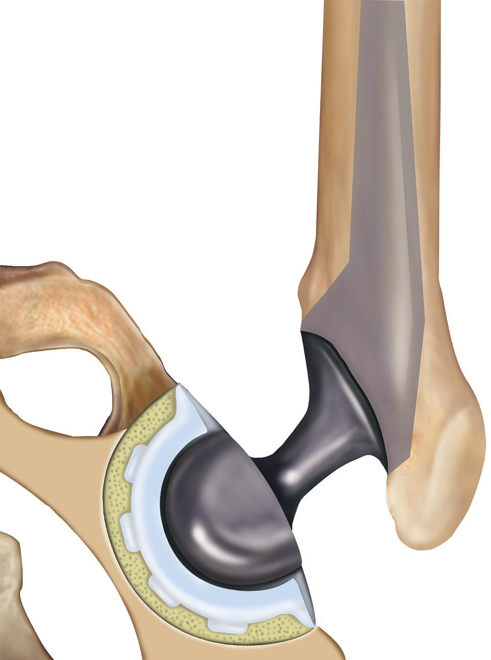 What is arthritis? Arthritis is a group of conditions that cause damage to one or more joints. Your surgeon has recommended a total hip replacement operation (see figure 1).