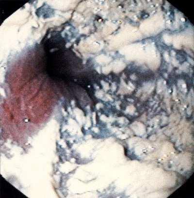 gastro-intestinal infection and relapse of gastric ulceration after