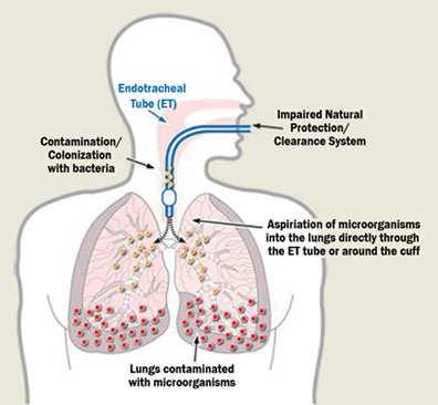 periodontal bacteria: Bind to lung epithelium Allow colonization by pulmonary