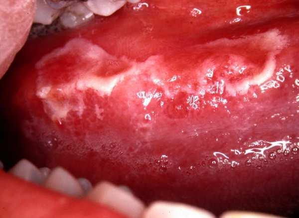 dental plaque biofilm.
