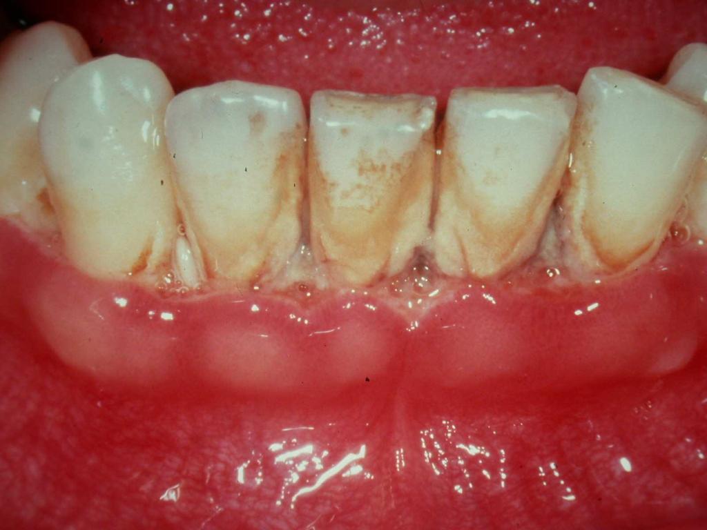 infections: Maxillary teeth