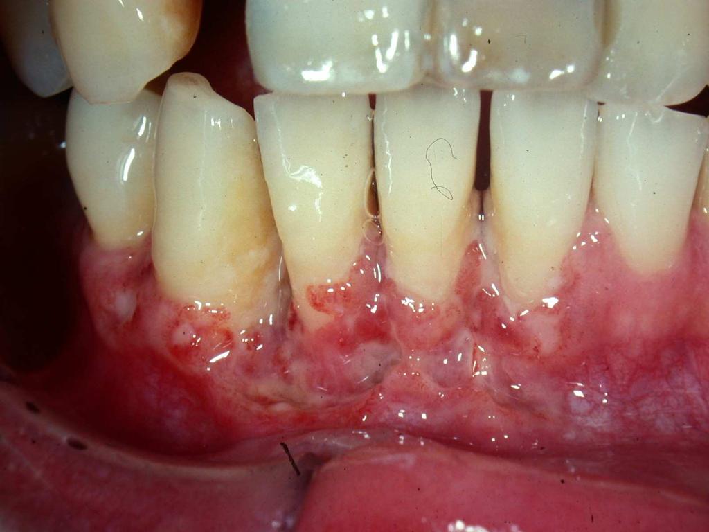 teeth Cavernous sinus