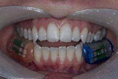 Erosion protection from a SnF 2 dentifrice (a) (b) Figure 2. Colour-coded in situ devices are fitted onto buccal positions in each subject.