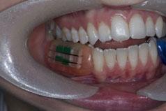 Immediately before the start of the treatment phase of the study, there was a 7-day period of acclimatisation using standard dentifrice products (manual toothbrush and fluoride dentifrice: Table 1).