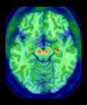 cognitive neocortex) Apathy, behavior Navigation, memory PPA Language Spatial,