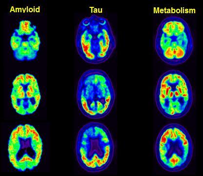 Tau PET: The New Frontier Amyloid, tau & brain metabolism 57 year-old AD Brain dysfunction correlates with tau but not amyloid Treatable Disorders That Present with Cogntive or Behavioral Problems