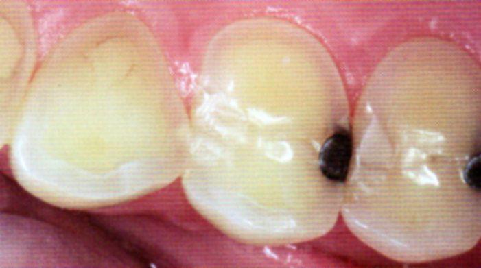 29 years old patient, reflux Dental