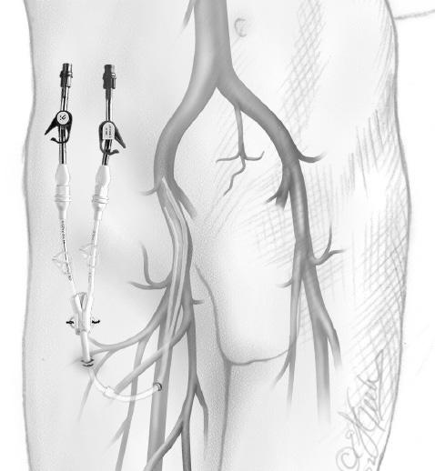Femoral Vein The patient should lie completely on his/her back. Both femoral arteries should be palpated for site selection and consequence assessment.