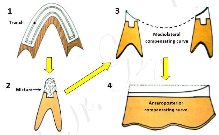 In this method used wax occlusion rims. A trench is made along the length of mandibular rim. A 1:1 mixture of pumice and dental plaster is loaded into the trench.