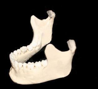 Functional Anatomy Mandible Is a U-shaped bone that supports the lower teeth It has no