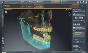 IN 4 SIMPLE STEPS Digital workflow with patient scan 1 X-ray scan with a Dentsply Sirona 3D X-ray system.