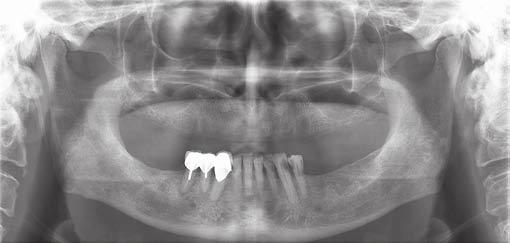 IJOPRD Rehabilitation of a Patient with Completely Edentulous Maxillary Arch using All on 4 Concept of Implantation Fig. 2: Preoperative panoramic view Fig.