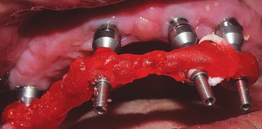 K Harshakumar et al Fig. 5: Postoperative panoramic view following implant placement patient was given oral hygiene instructions and a recall appointment was given after 2 weeks.