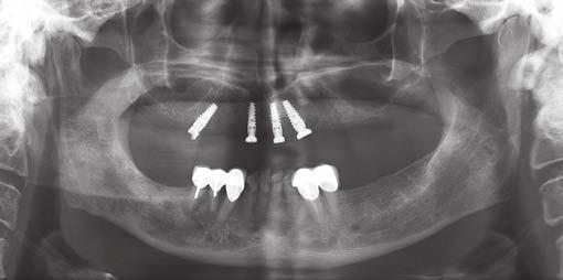 Following a 6 months healing period, all the four implants were loaded with multiunit abutments (Fig. 6), subsequently prosthetic phase was initiated.