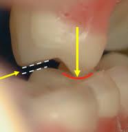 between maxillary molars palatal cusps and