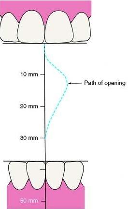 In the periodontium: Widening of the periodontal ligament (this is the very early sign of a traumatic occlusion), isolated or circumferential periodontal pockets.