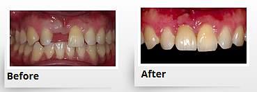 The Single Tooth Solution If you are missing only one tooth,