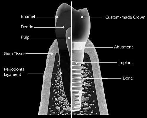 foundation for your new tooth or teeth to be attached.