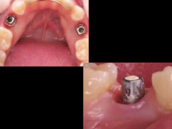 Case 1 Example: In general, there are two methods for restoring the implant: the Direct and Indirect impression procedures.