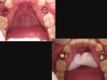 The first case illustrates implants replacing two mandibular congenitally missing implants in a 21-year-old female. The surgical dentist placed 4.