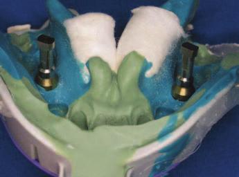 Three months later, the implants were torque tested to confirm their readiness for final restoration. The temporary crowns were removed revealing well defined sulci around the titanium abutments (Fig.