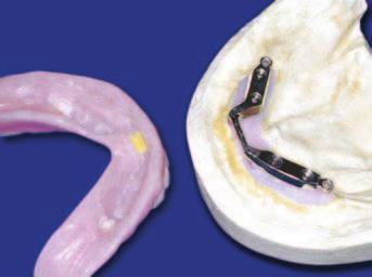 This format is called a Closed-tray impression in which the impression copings are imprinted and remain bolted into the implants after the impression is removed from the mouth.