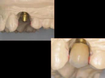 The white healing cap was removed and a yellow impression coping seated onto the Snappy Abutment (Fig. 13).