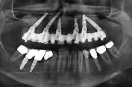 3 x 15 mm implants were placed at sites 23 and 26 with corresponding multi-unit abutments angulated by 30 degrees. The required primary stability was achieved for all six implants.