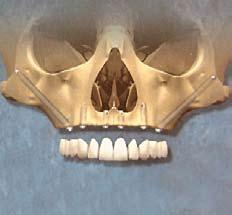 Zygomaticus Implants Zygomaticus are long implants that are inserted into the underside of the cheek bones