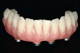 All-On-4 All-On-4 refers to all teeth being supported by only four implants.