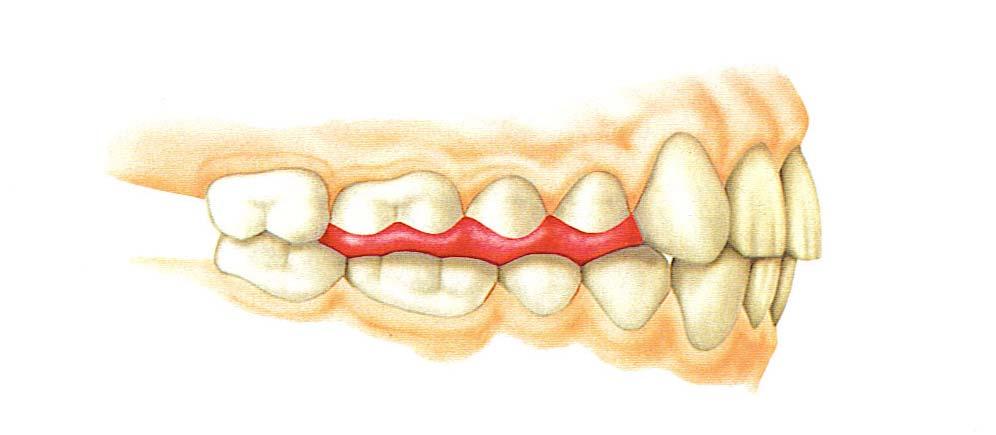 the prepared teeth if the path is to accurately represent the complete functional and parafunctional movements.