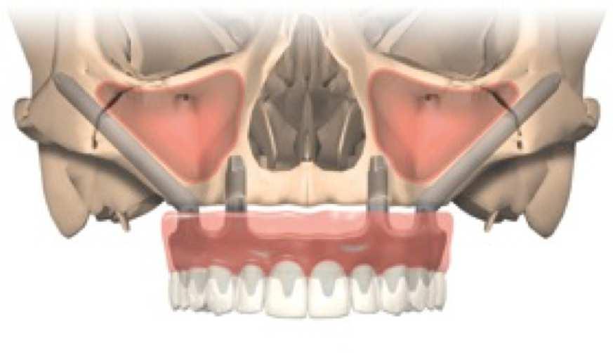 Zygomatic Implants Graftless Implant Solution For severely resorbed or bone deficient upper jaw Bone atrophy is a natural phenomenon that occurs after the extraction of teeth, and which is