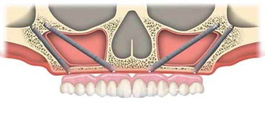 Quad Zygoma Surgery In some extreme cases, the upper jaw may be deficient in bone even in the interior