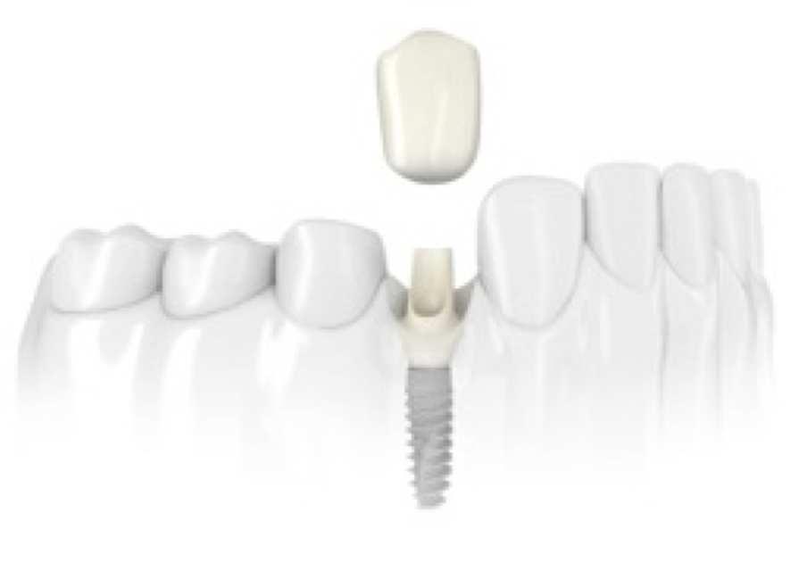 Single Tooth Replacement Once the implant is surgically placed, the bone bonds with the titanium (a process called integration ), creating a strong foundation for artificial teeth.