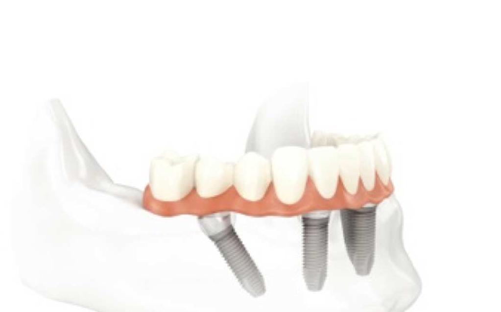 All-on-4 treatment concept (Graftless solution) Teeth in a day procedure! What is the All-on-4 treatment concept?
