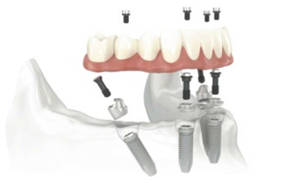 This revolutionary technique allows surgeons to gain optimal results as they provide the required support for total rehabilitation of the mouth.