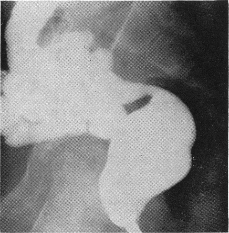 assessment of rectal involvement. A second group of patients showed rectal involvement of a more advanced degree, which was judged to make these patients unsuited for primary ileorectal anastomosis.