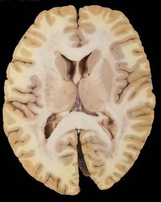 The structure of cerebral hemipheres includes: Superficial layer of grey matter, the cerebral cortex.
