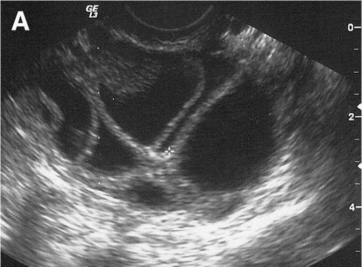 Figure 2 Ovarian follicles, stimulated by ovulation medications, visible on ultrasound. The dark, circular areas are the follicles.