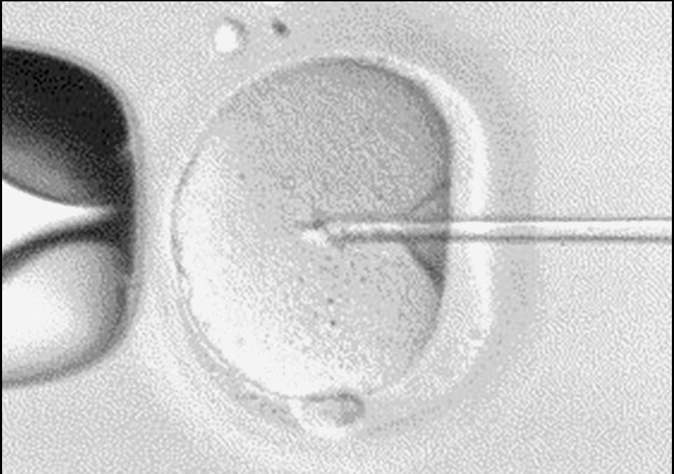 Sperm Injection. Visualization of two pronuclei the following day confirms fertilization of the egg. One pronucleus is derived from the egg and one from the sperm.