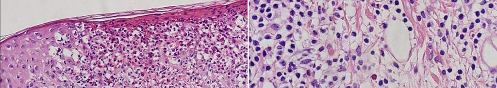 International Journal of Case Reports in Medicine 4 Figure 2: (A) Marked infiltration of eosinophils into hair follicles and perifollicular areas Discussion with (B) dermal lymphocytic infiltration