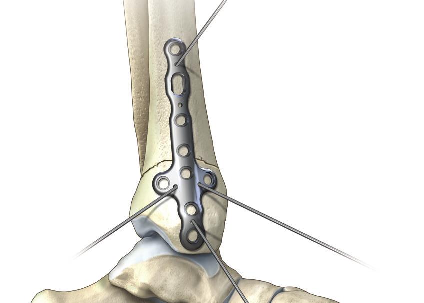 The incision for a medial malleolar or medial pilon fracture is made over the medial aspect of the distal tibia along the course of the saphenous nerve and vein curving over the distal medial