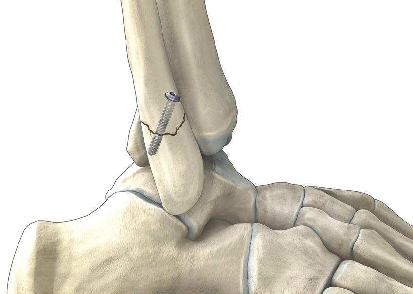 malleolus. The peroneal tendons are mobilized and retracted. A lateral window can be made in the ankle capsule in order to expose the weight-bearing surface of the plafond.