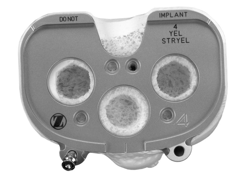 Zimmer NexGen Trabecular Metal Tibial Tray Surgical Technique 5 Drilling Peg Holes The Trabecular Metal Tibial Drill Guide has two distinct ends that dictate the