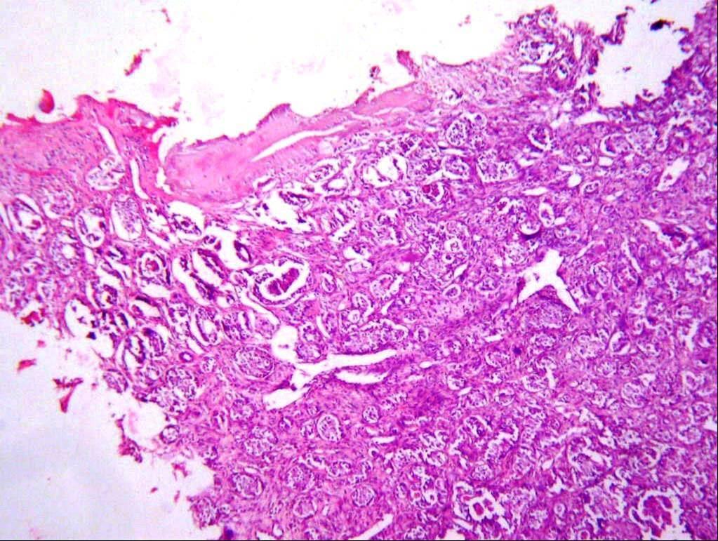 Figure 2: Tumor Cells Arranged