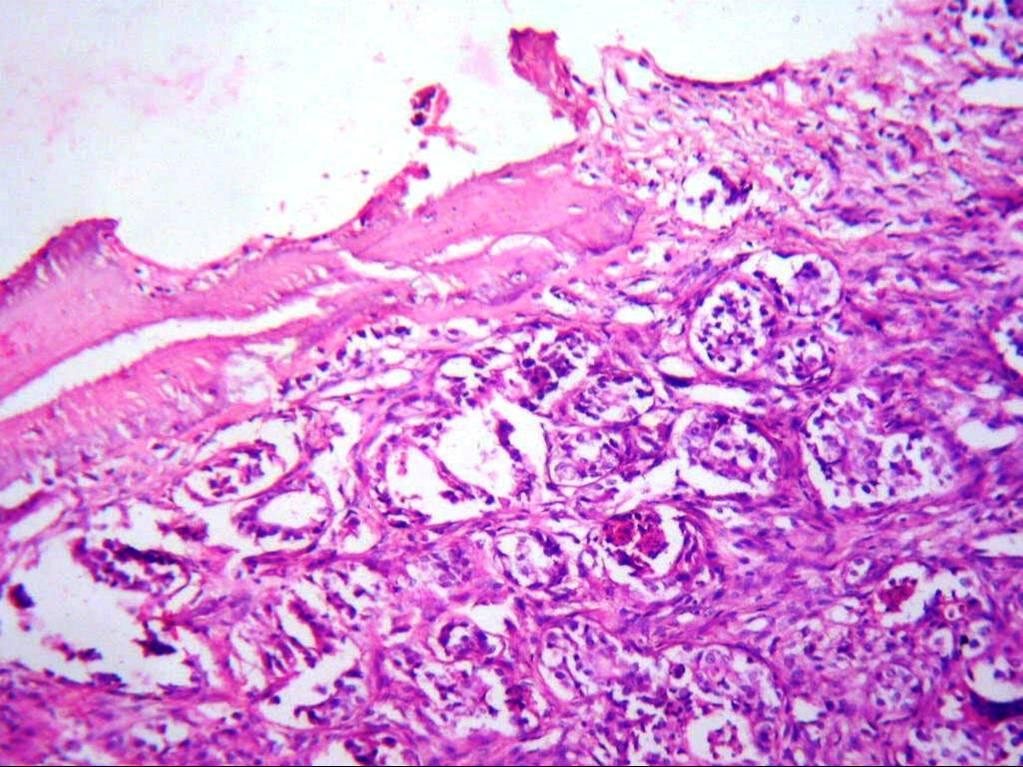 Figure 3: Tumor Cells in