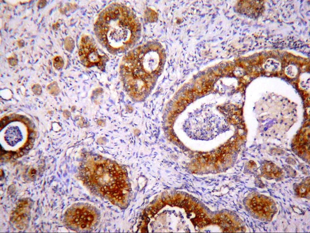 Immunohistochemistry (IHC): Showed positivity for CK7 (Figure 4) while CK 20 was negative.