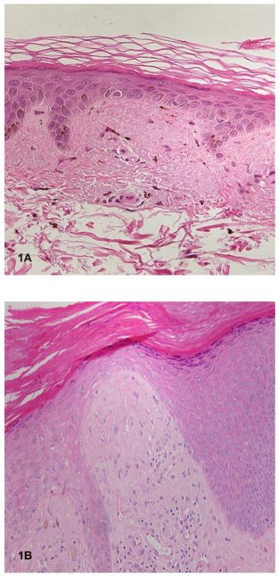 esinophilic deposits within widened dermal papillae (Figure 1). However, the quantity of the deposits varied. In 2 of the cases, the deposits were very minimal and questionable.