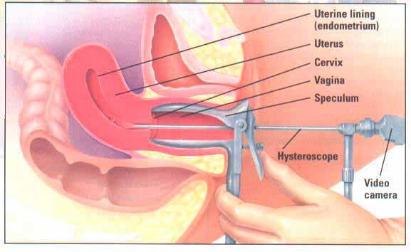 The hysteroscope (telescope) is inserted through the cervix to visualize the lining of the womb Procedure The procedure of a hysteroscopy/d&c is most often done under light general anaesthesia or